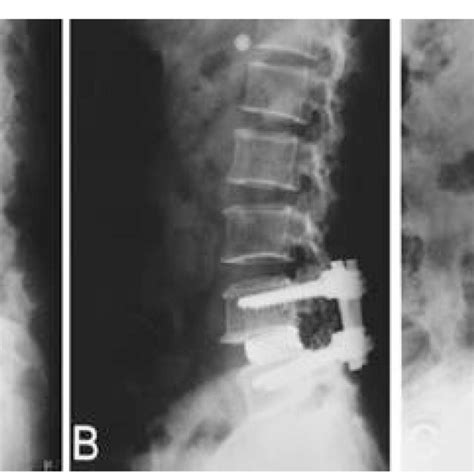 Isthmic Spondylolisthesis With Plf And Plif A Lateral Radiograph Of