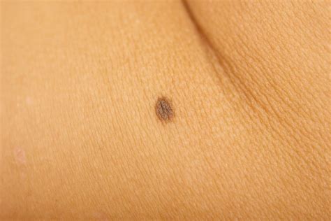 Is This Mole Dangerous The Truth About Detecting Skin Cancer