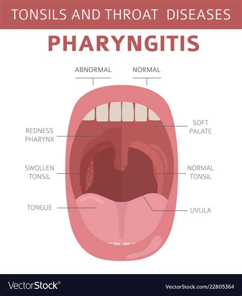 Tonsils And Throat Diseases Pharyngitis Symptoms Vector Image