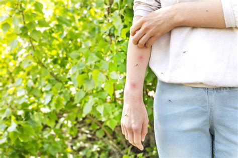 10 Home Remedies To Treat Mosquito Bites Health Enews