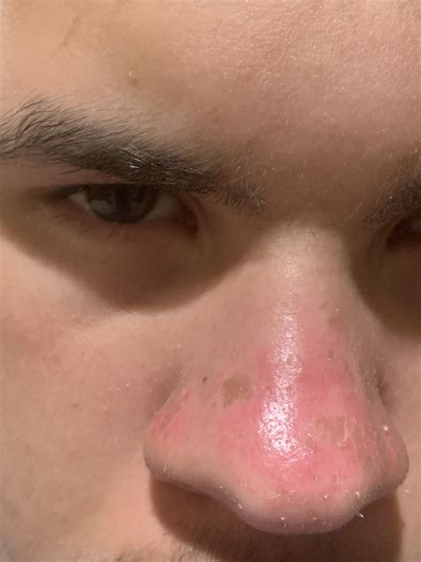 Brown Spots Appearing On Nose After Sunburn Rdermatologyquestions