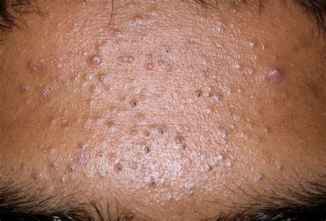Blackheads Causes Treatment And How To Get Rid Of Blackheads