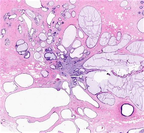 Pathology Outlines Radial Scar Complex Sclerosing Lesion