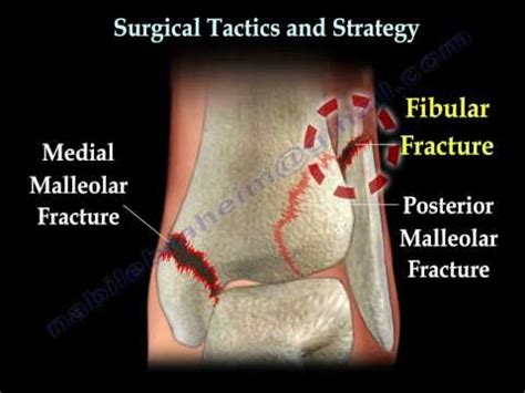 Ankle Fractures Surgical Treatment Tactics Everything You Need To