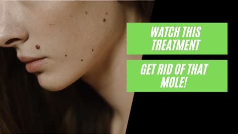 How To Remove A Mole On Your Face And Neck Youtube