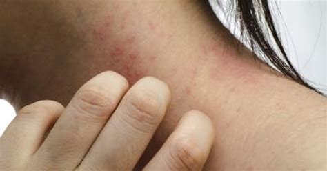 Home Remedies To Stop An Itchy Rash Livestrongcom