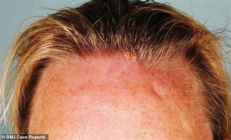 British Travellers Swollen Forehead Turns Out To Be Maggots No