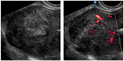 Diagnostics Free Full Text Ultrasound Guided Trans Uterine Cavity