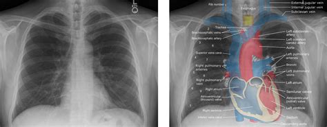 Chest radiographs are the most common film taken in medicine. Chest XRay Anatomy Labeled #Clinical #Radiology #Anatomy ...