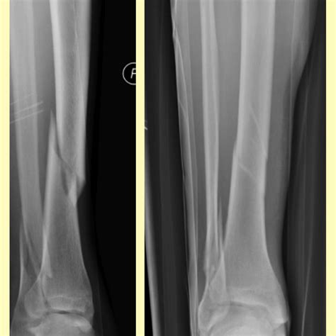 Pdf Fractures Of The Tibial Shaft In Adults