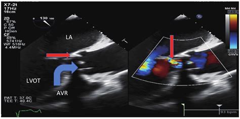 Transesophageal Echocardiogram Showed Severe Intravalvular Aortic