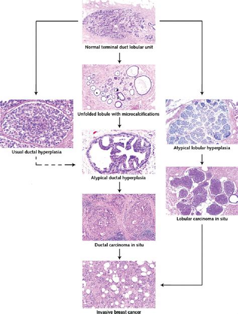 Theory Of Linear Progression Proposed Histologic Evolution Of Breast