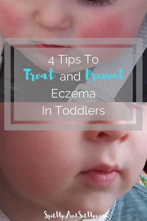 How To Treat Eczema In Toddlers And Babies Toddler Eczema How To