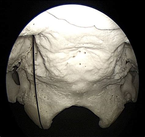 Ventral Skull Base During Medial Condylectomy Neuroanatomy The