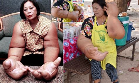 Thai Womans Hands Thought To Be Biggest In The World Daily Mail Online