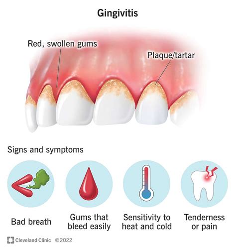 Gingivitis Causes Symptoms And Treatment Options Hot Sex Picture