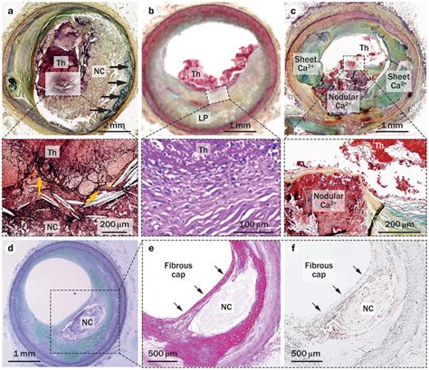 Morphological Features Of Atherothrombosis A Plaque Rupture A