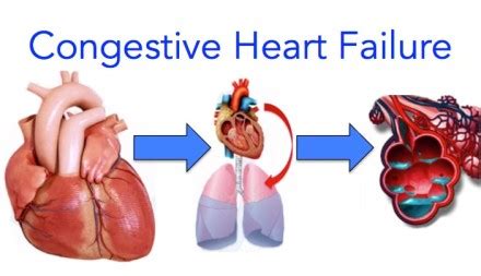Congestive Heart Failure Video Symptoms Treatment