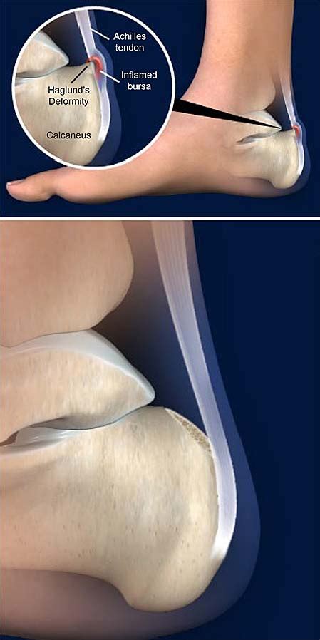 Resection Of Haglunds Deformity Central Coast Orthopedic Medical Group