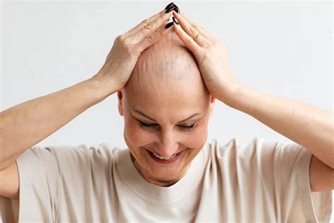 Todo Sobre La Alopecia Universal Bella Salud ️