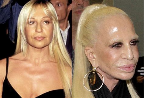 Antes Y Después De 12 Famosos Que Se Pasaron Con El Botox O Los Malos