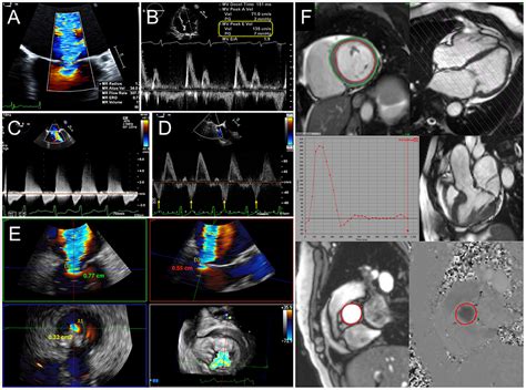 Frontiers Multimodality Cardiac Imaging For Procedural Planning And