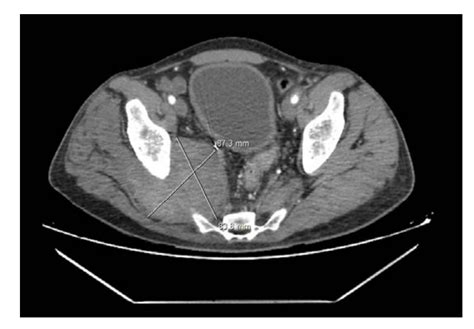 Pseudoaneurysms Of The Gluteal Arteries Vdm