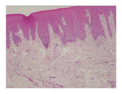 Photomicrograph Of The Section Shows Normal Buccal Mucosa Hande 10x