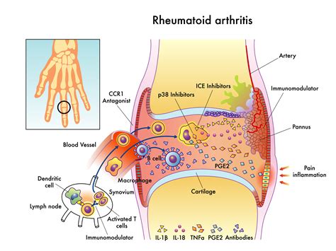 Rheumatoid Arthritis The Pain Relief Clinic