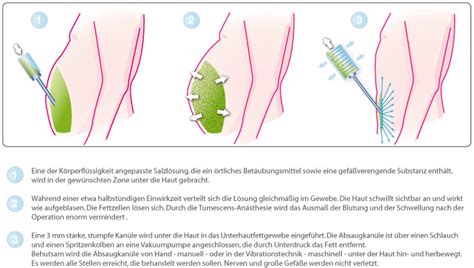 Geschädigte gelenke, um nur einige folgeerkrankungen zu nennen. Fettabsaugen Bauch Bilder Information Problemzonen