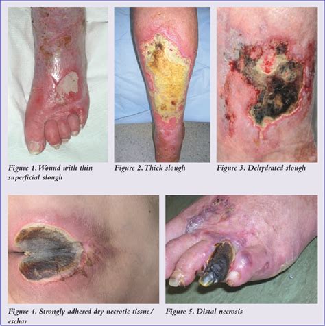 Whether the tissue is dead, infected, damaged or contaminated, removing it from the body leaves only healthy tissue to fight infection and promote healing. PDF Understanding methods of wound debridement ...
