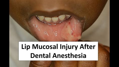 Lip Mucosal Trauma After Dental Anesthesia Youtube