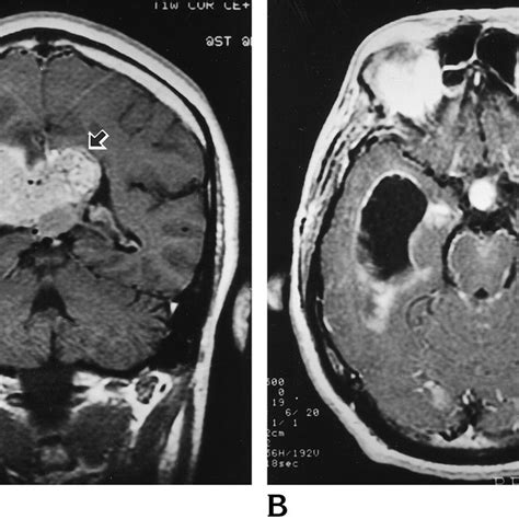 Case 1 43 Year Old Man With Diplopia Blurred Vision And Occipital