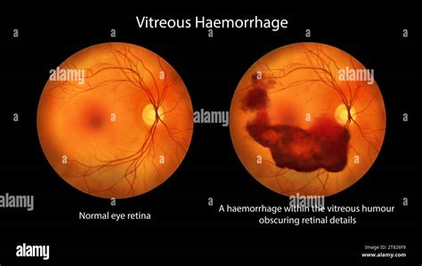 Illustration Depicting Vitreous Haemorrhage Observed During