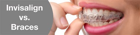 Invisalign Vs Braces Cosmetic Dentist In Toronto