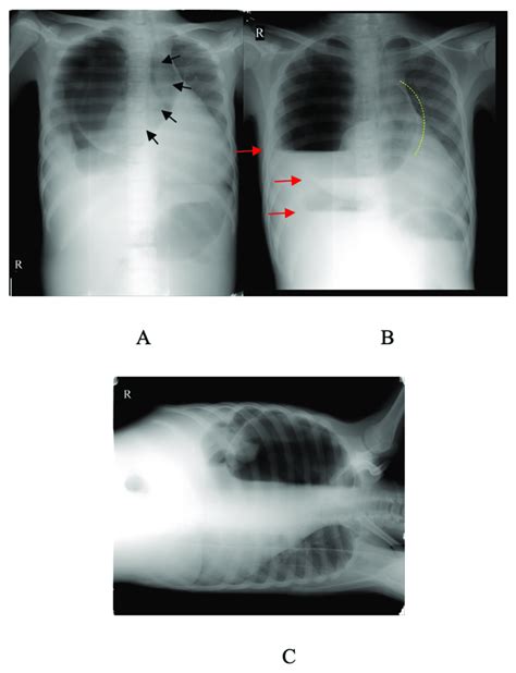 Chest Radiograph With Positions A Ap Supine B Erect C Left