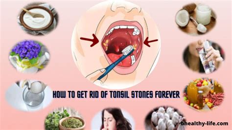 How To Get Rid Of Tonsil Stones Forever Bhealthy Life