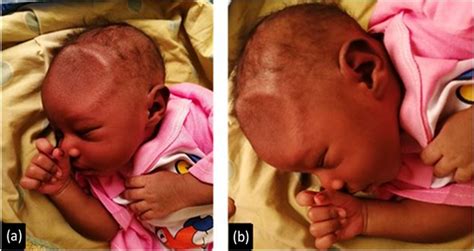 Congenital Depressed Skull Fracture Due To Maternal Fetal Trauma