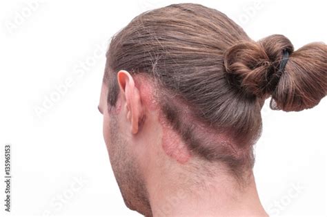 Red Psoraitic Spot On Back Of Head And Scalp Hairline Dermatological