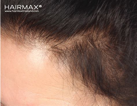 Hairmax Hairmax Before After Photos