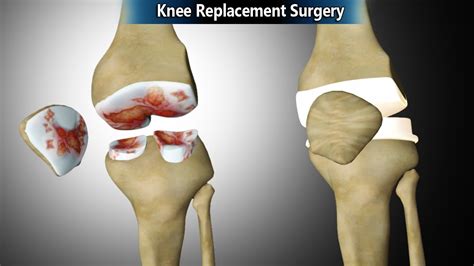 Total Knee Replacement Surgical Procedure Video Animation Youtube