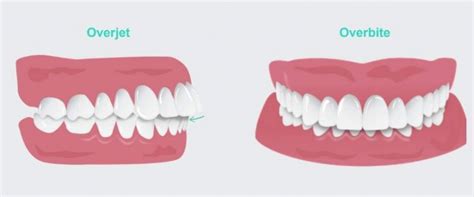 Overjet Vs Overbite How Are They Different