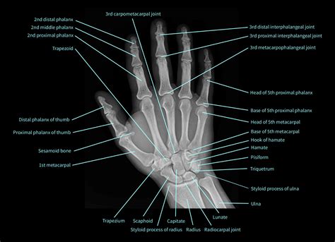 Labeled Normal Hand X Rays