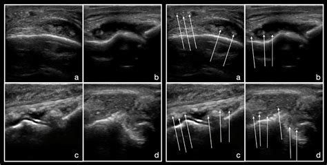 Cureus Images In Primary Care Medicine Point Of Care Ultrasound In Gout