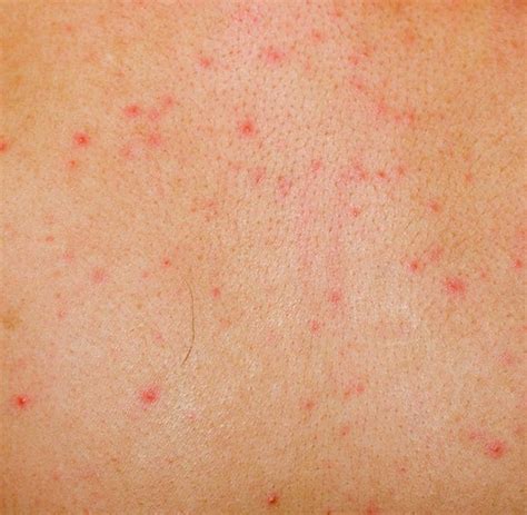 Red Dots On Legs Red Bumps On Legs Thighs Like Pimples Small