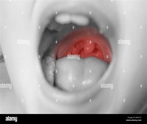 Healthy Tonsils Hi Res Stock Photography And Images Alamy