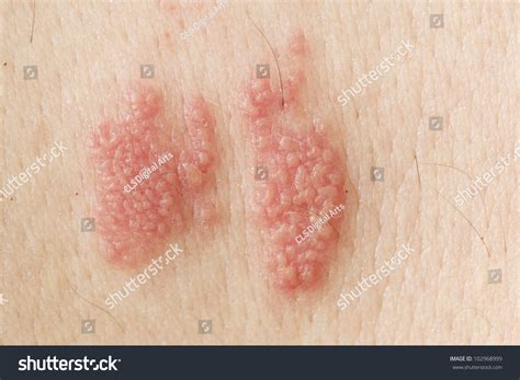 Raised Red Bumps Blisters Caused By Stock Photo 102968999 Shutterstock