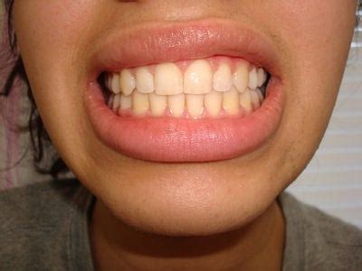 The term buck teeth describes teeth that are too far forward and often projects over the lower lip. Gaps + Whitening After Braces? (photo) Dentist Answers, Tips
