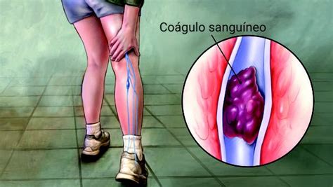 A trombose venosa nas pernas é causada por um coágulo (trombo) sanguíneo localizado numa veia profunda, que pode se tornar inchaço nas pernas; O que é trombose venosa profunda: sintomas e formas de ...
