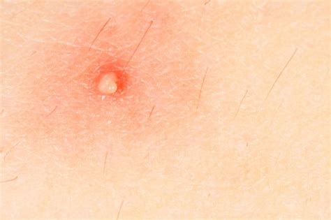 What Is Molluscum Contagiosum Medical News Today